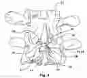 Fig. 05 - Spline Implant