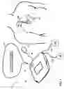 Fig. 02 - Defibrillator with implantable medical device detection