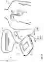 Fig. 04 - Defibrillator with implantable medical device detection