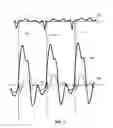Fig. 02 - Method, apparatus, and system to optimize cardiac preload based on measured pulmonary artery pressure