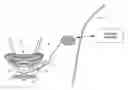 Fig. 01 - Method and Apparatus for Treating Incontinence