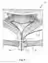 Fig. 05 - Method and Apparatus for Treating Incontinence