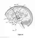 Fig. 35 - Systems and Methods for Treating Neurological Disorders by Light Stimulation