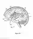 Fig. 37 - Systems and Methods for Treating Neurological Disorders by Light Stimulation
