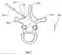 Fig. 14 - Methods for treating the thoracic region of a patient's body