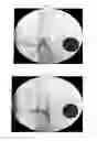 Fig. 04 - ENDOVASCULAR DEVICE WITH MEMBRANE