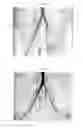 Fig. 05 - ENDOVASCULAR DEVICE WITH MEMBRANE