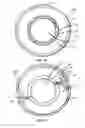 Fig. 16 - Methods and Devices for Coupling a Device Insertable within a Mammalian Body