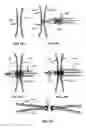 Fig. 66 - Methods and Devices for Coupling a Device Insertable within a Mammalian Body