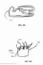 Fig. 68 - Methods and Devices for Coupling a Device Insertable within a Mammalian Body