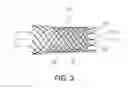 Fig. 03 - Atraumatic stent with reduced deployment force, method for making the same and method and apparatus for deploying and positioning the stent
