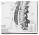 Fig. 06 - Interventional medical device for use in MRI