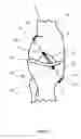 Fig. 05 - Elastic metallic replacement ligament