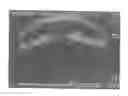 Fig. 01 - Ultrasonically Detectable Intrauterine System and a Method for Enhancing Ultrasound Detection