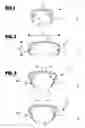 Fig. 02 - Clip-like implant for osteosynthesis