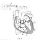 Fig. 02 - Self-referencing communication in implantable devices