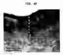 Fig. 44 - Methods And Devices For Fractional Ablation Of Tissue For Substance Delivery