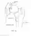 Fig. 09 - Method and apparatus for re-attaching the labrum of a hip joint