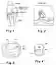 Fig. 02 - Cartilage allograft plug