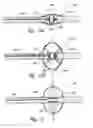 Fig. 16 - METHODS AND SYSTEMS FOR THERMALLY-INDUCED RENAL NEUROMODULATION