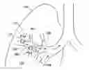 Fig. 01 - METHODS FOR MAINTAINING THE PATENCY OF  COLLATERAL CHANNELS IN THE LUNGS USING CRYO-ENERGY