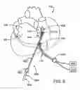 Fig. 09 - Cardiac treatment devices and methods