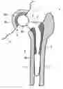 Fig. 01 - IMPLANTABLE PROSTHESIS