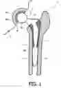 Fig. 02 - IMPLANTABLE PROSTHESIS