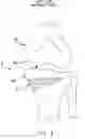 Fig. 04 - Method and apparatus for reconstructing a ligament and/or repairing cartilage, and for performing an open wedge, high tibial osteotomy