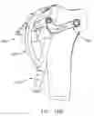 Fig. 28 - Method and apparatus for reconstructing a ligament and/or repairing cartilage, and for performing an open wedge, high tibial osteotomy