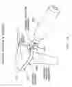 Fig. 33 - Method and apparatus for reconstructing a ligament and/or repairing cartilage, and for performing an open wedge, high tibial osteotomy