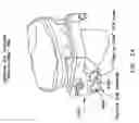 Fig. 49 - Method and apparatus for reconstructing a ligament and/or repairing cartilage, and for performing an open wedge, high tibial osteotomy