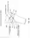 Fig. 65 - Method and apparatus for reconstructing a ligament and/or repairing cartilage, and for performing an open wedge, high tibial osteotomy