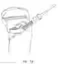 Fig. 69 - Method and apparatus for reconstructing a ligament and/or repairing cartilage, and for performing an open wedge, high tibial osteotomy