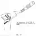 Fig. 76 - Method and apparatus for reconstructing a ligament and/or repairing cartilage, and for performing an open wedge, high tibial osteotomy