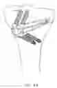 Fig. 79 - Method and apparatus for reconstructing a ligament and/or repairing cartilage, and for performing an open wedge, high tibial osteotomy