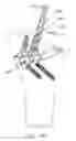 Fig. 83 - Method and apparatus for reconstructing a ligament and/or repairing cartilage, and for performing an open wedge, high tibial osteotomy