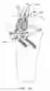 Fig. 84 - Method and apparatus for reconstructing a ligament and/or repairing cartilage, and for performing an open wedge, high tibial osteotomy