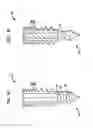 Fig. 06 - Methods for anchoring suture to bone