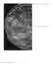Fig. 06 - Breast tomosynthesis with display of highlighted suspected calcifications