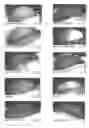 Fig. 06 - Antisense oligonucleotides capable of inhibiting the formation of capillary tubes by endothelial cells and methods of treating ophthalmic and dermatological diseases