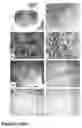 Fig. 06 - Methods of treating neurological conditions with hematopoeitic growth factors