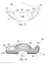 Fig. 09 - Method and clamping apparatus for external fixation and stabilization