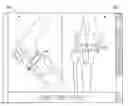 Fig. 01 - Customized patient surgical plan