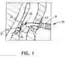 Fig. 02 - Balloon cuff tracheostomy tube