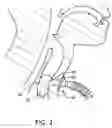 Fig. 03 - Balloon cuff tracheostomy tube