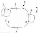 Fig. 07 - Balloon cuff tracheostomy tube