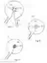 Fig. 04 - OVER-SPRAY CAPTURING DEVICE AND ITS USE