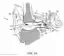 Fig. 02 - Energy delivery and microphone placement methods for improved comfort in an open canal hearing aid