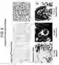Fig. 08 - IDENTIFICATION OF AN ERBB2 GENE EXPRESSION SIGNATURE IN BREAST CANCERS